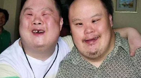 Why Do Down Syndrome People Look the Same?